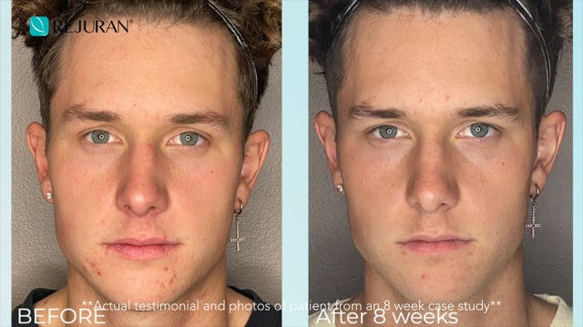 Advanced Scar Gel Testimonial Video
